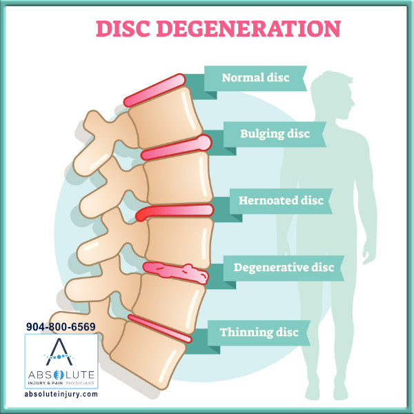 Different Types Disc Injuries